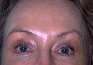 Botox® Before and After Results