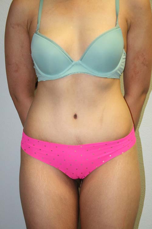 After picture of a tummy tuck procedure without abdominal scarring