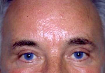 Male Eyelid Surgery (Blepheroplasty)