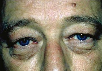 Male Eyelid Surgery (Blepheroplasty)