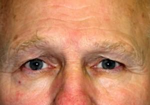 Male Eyelid Surgery (Blepheroplasty)