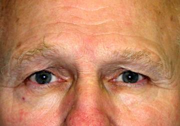 Male Eyelid Surgery (Blepheroplasty)