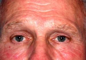 Male Eyelid Surgery (Blepheroplasty)