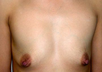 Breast Augmentation