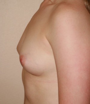 Breast Augmentation