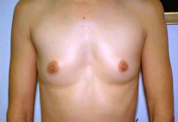 Breast Augmentation