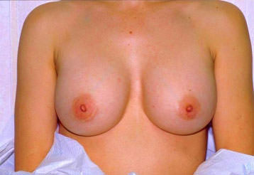 Breast Augmentation