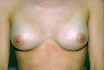 Breast Augmentation