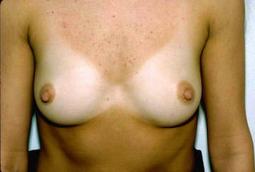 Breast Augmentation