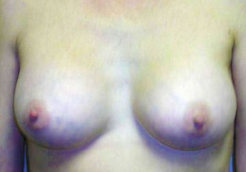 Breast Augmentation