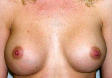 Breast Augmentation