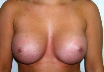 Breast Augmentation