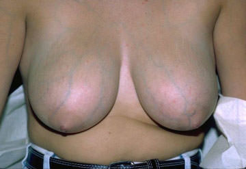 Breast Reduction