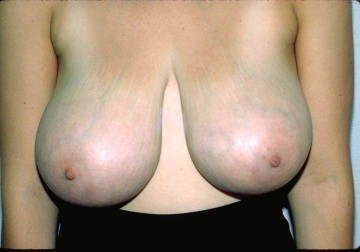 Breast Reduction