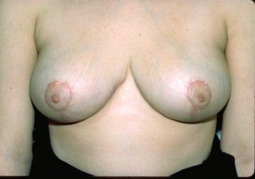 Breast Reduction