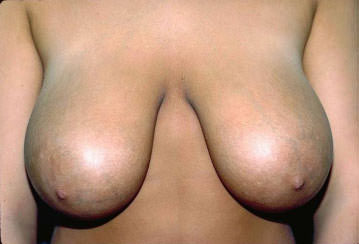 Breast Reduction