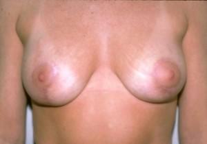 Breast Lift / Mastopexy