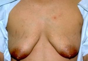 Breast Lift / Mastopexy