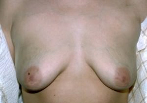 Breast Lift / Mastopexy