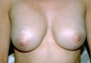 Breast Lift / Mastopexy