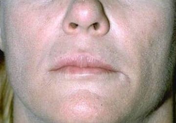 Cheek Augmentation