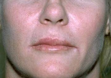 Cheek Augmentation