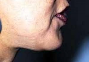 Chin Augmentation