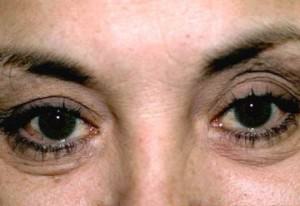  Eyelid Surgery (Blepheroplasty)