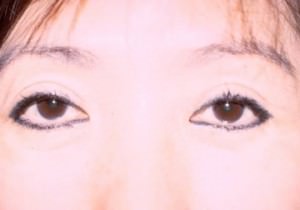  Eyelid Surgery (Blepheroplasty)