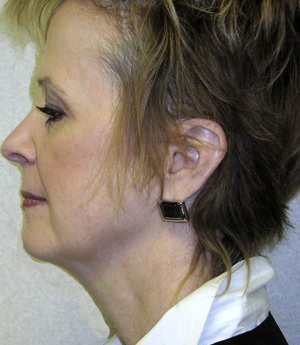 Forehead, Face and Neck Lift