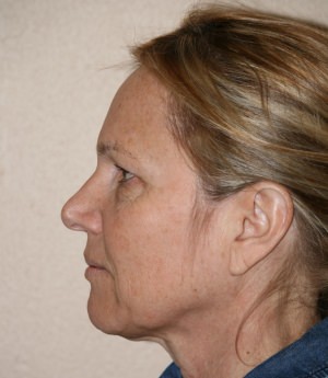 Forehead, Face and Neck Lift