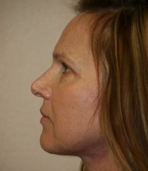 Forehead, Face and Neck Lift