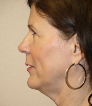 Forehead, Face and Neck Lift