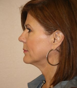 Forehead, Face and Neck Lift