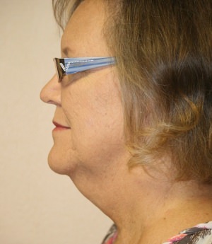 Forehead, Face and Neck Lift