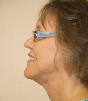 Forehead, Face and Neck Lift