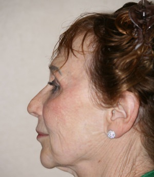 Forehead, Face and Neck Lift