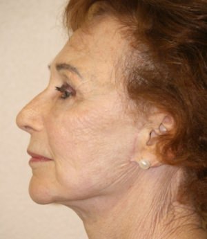 Forehead, Face and Neck Lift