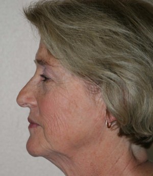 Forehead, Face and Neck Lift
