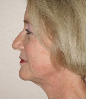 Forehead, Face and Neck Lift