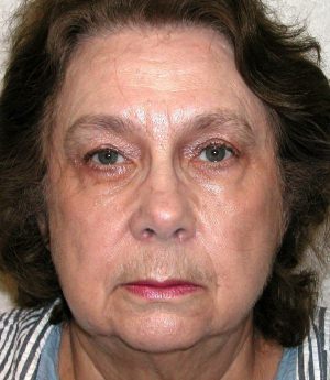 Forehead, Face and Neck Lift