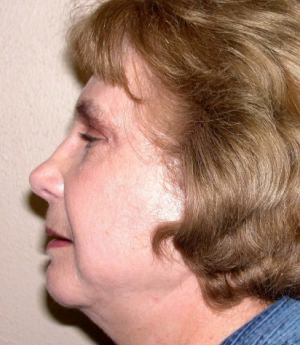 Forehead, Face and Neck Lift