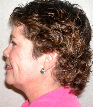 Forehead, Face and Neck Lift