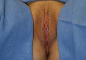 Labiaplasty