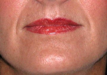  Lip enhancement