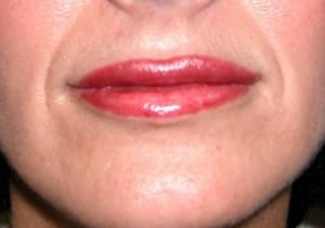  Lip enhancement