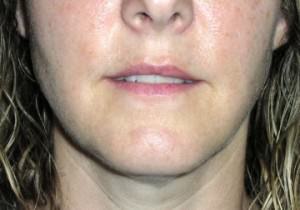  Lip enhancement