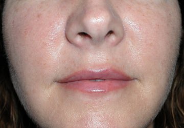  Lip enhancement