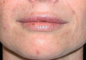  Lip enhancement