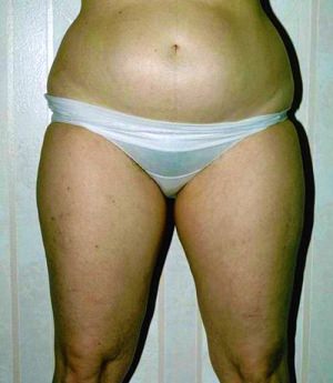 Liposuction Case 3408 Before Photo Liposuction